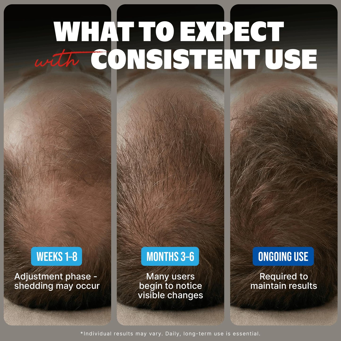 Minoxidil-5% Extra Strength Hair Regrowth for Men, 6 Month Supply